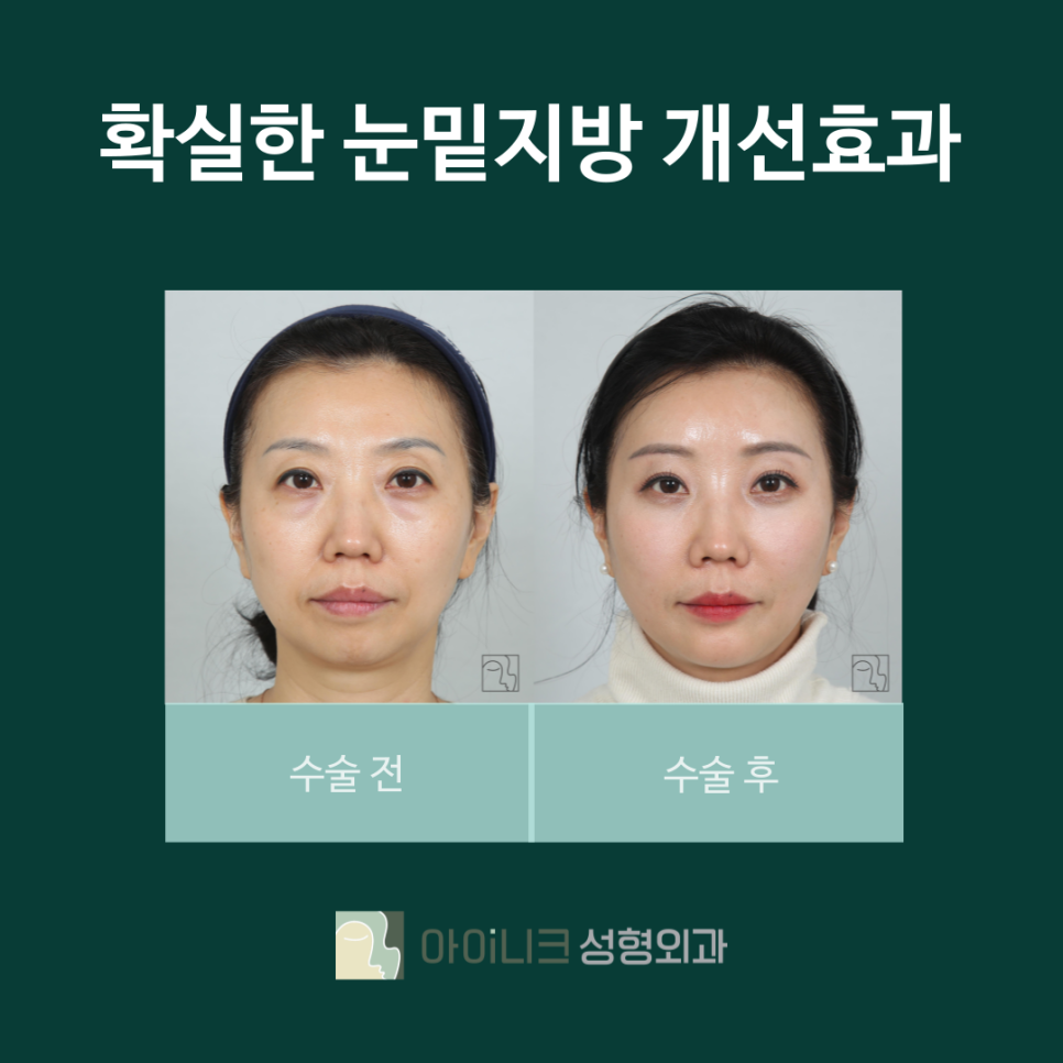 서울압구정눈밑지방재배치 잘하는곳 아이니크에서 환한 얼굴로 개선 관련 이미지 3