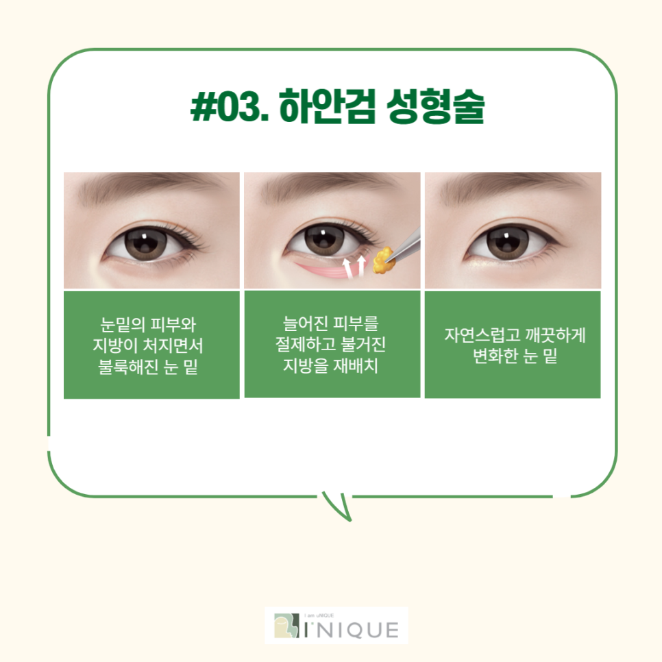 중년눈성형을 통해 다시 젊고 자신있게! 관련 이미지 4