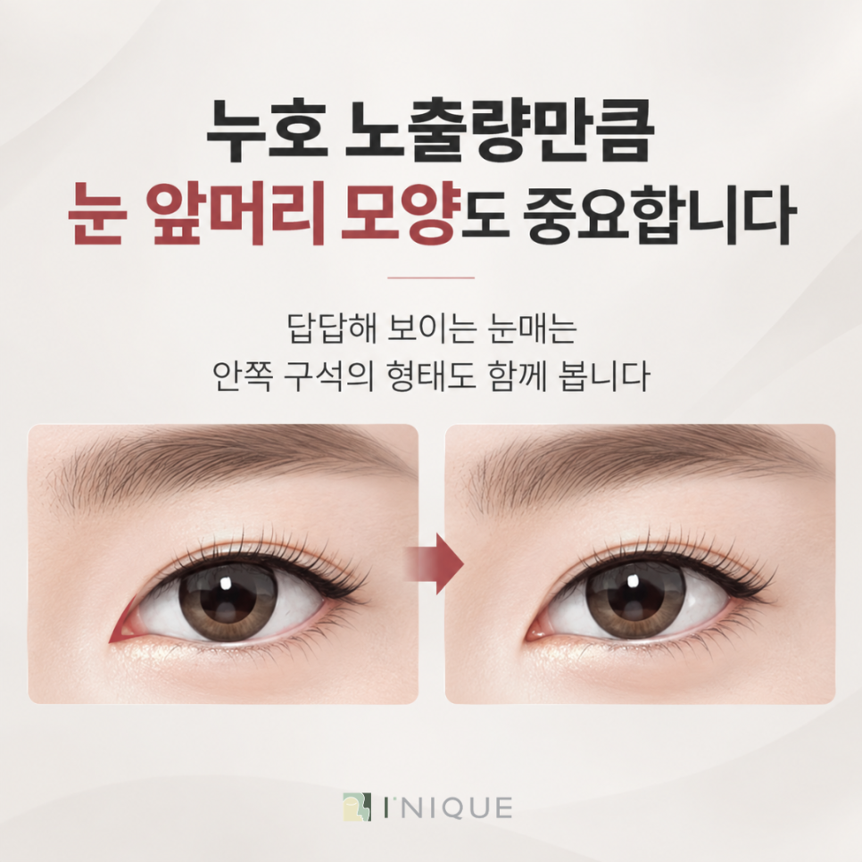 앞트임 재수술 복원 기간, 얼마나 기다려야 할까요? 관련 이미지 5