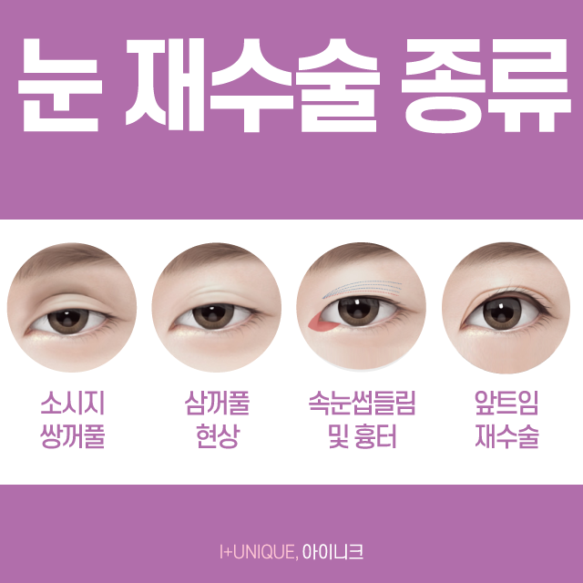 눈재수술 잘하는 곳 신중하게 선택해야하죠! 관련 이미지 2