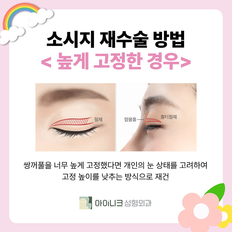 Revision Surgery for “Sausage Eyes”: How Should Thick Double-Eyelid Folds Be Corrected? image 3