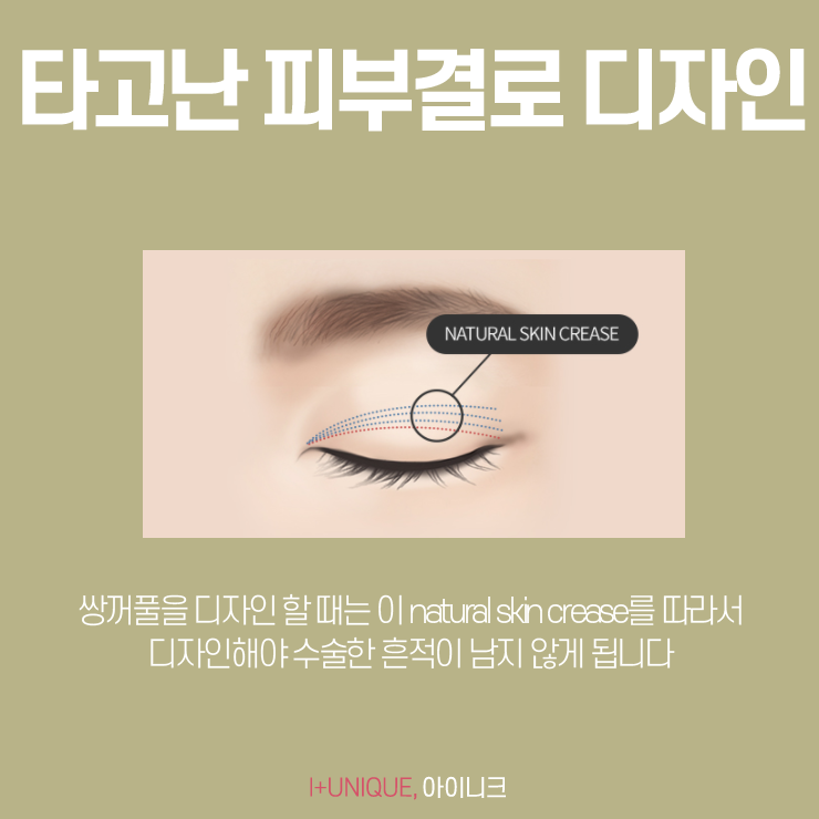 쌍커풀잘하는곳 찾고 있다면 이건 확인해 봐야죠! 관련 이미지 5