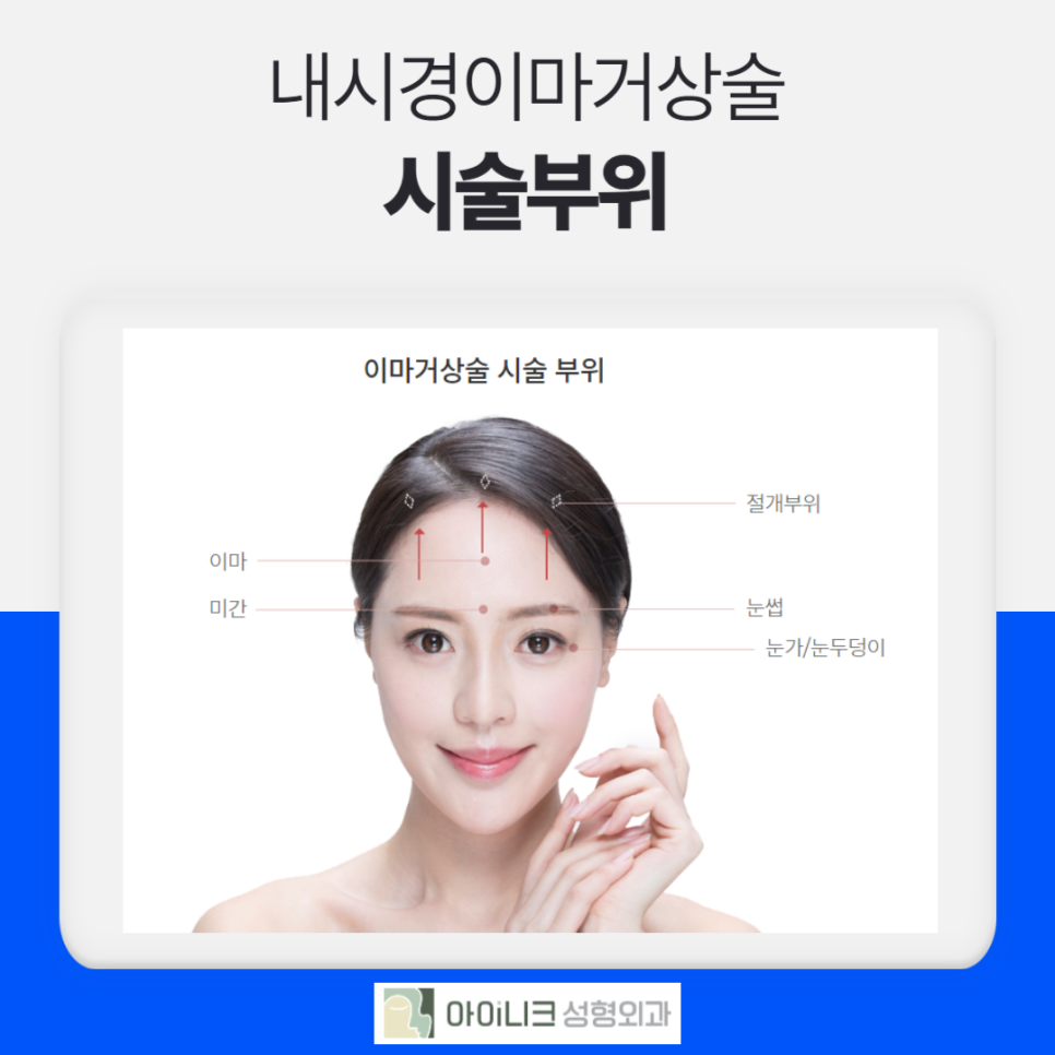 내시경이마거상술 안전하고 확실하게 관련 이미지 2