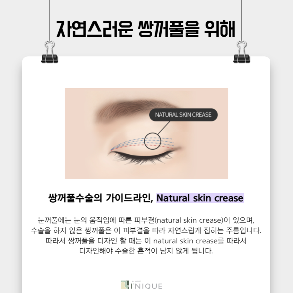 Before and After Double Eyelid Surgery, Naturally Beautiful AINIQUE image 5