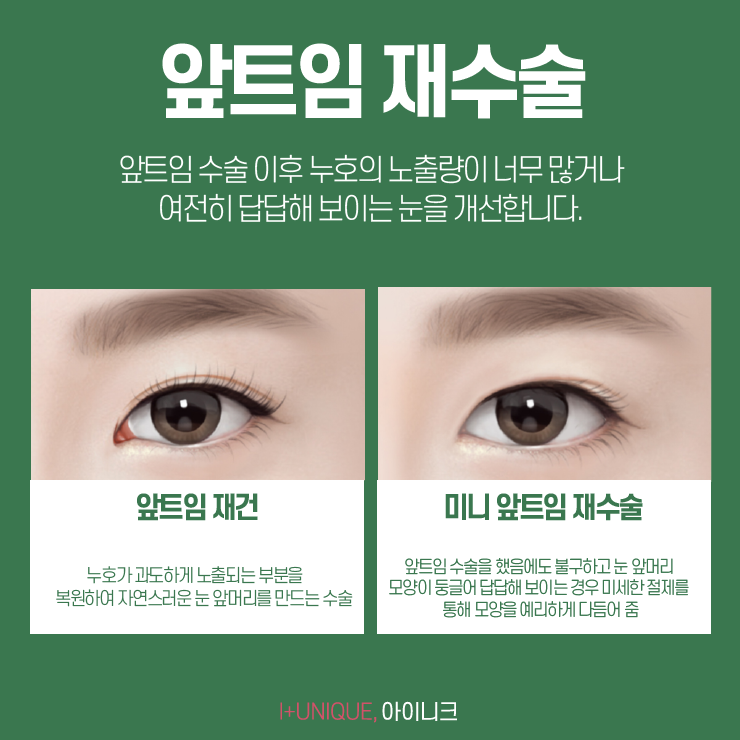 앞트임잘하는곳 찾아야 하는 이유! 아이니크성형외과에서 알려드립니다. 관련 이미지 5