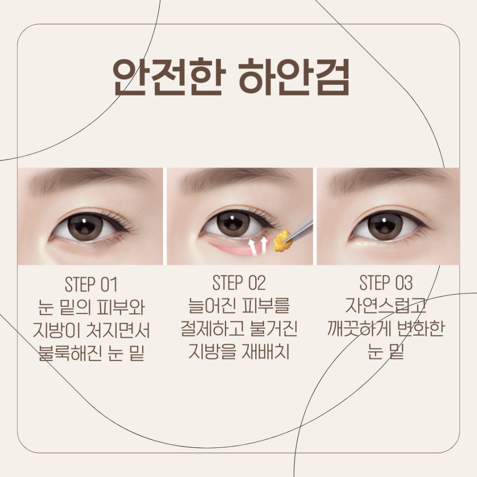 This Method Recommended by iNique Rather Than Upper Blepharoplasty image 5