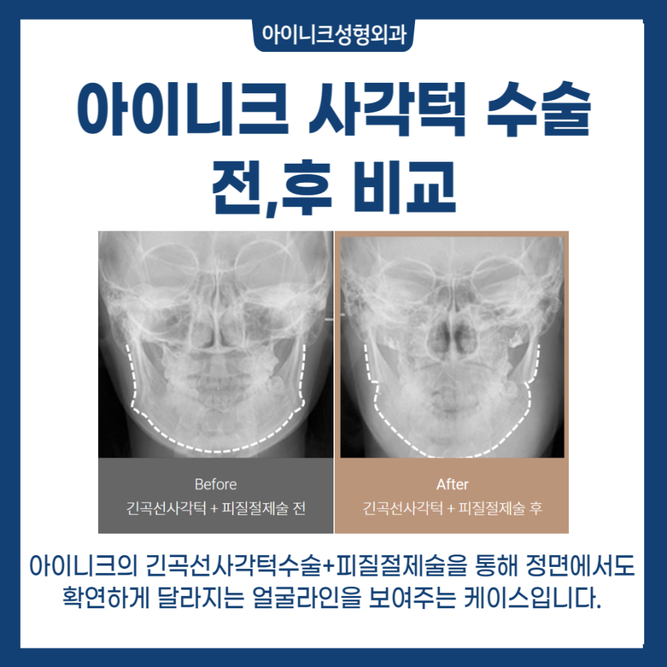 자연스러운 V라인 사각턱성형 관련 이미지 6
