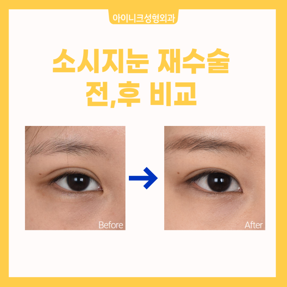 Creating Natural-Looking Eyes with Double Eyelid Line Revision Surgery image 5