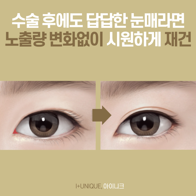 앞트임복원을 고민 중이라면 아이니크에서 가격까지 한 번에 상담받자! 관련 이미지 4