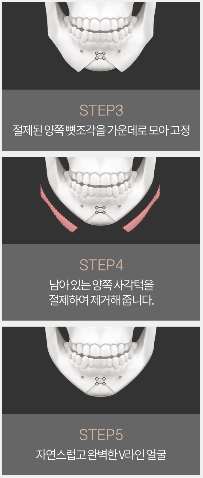 턱끝축소술비용 합리적인 선택, 아이니크! 관련 이미지 5