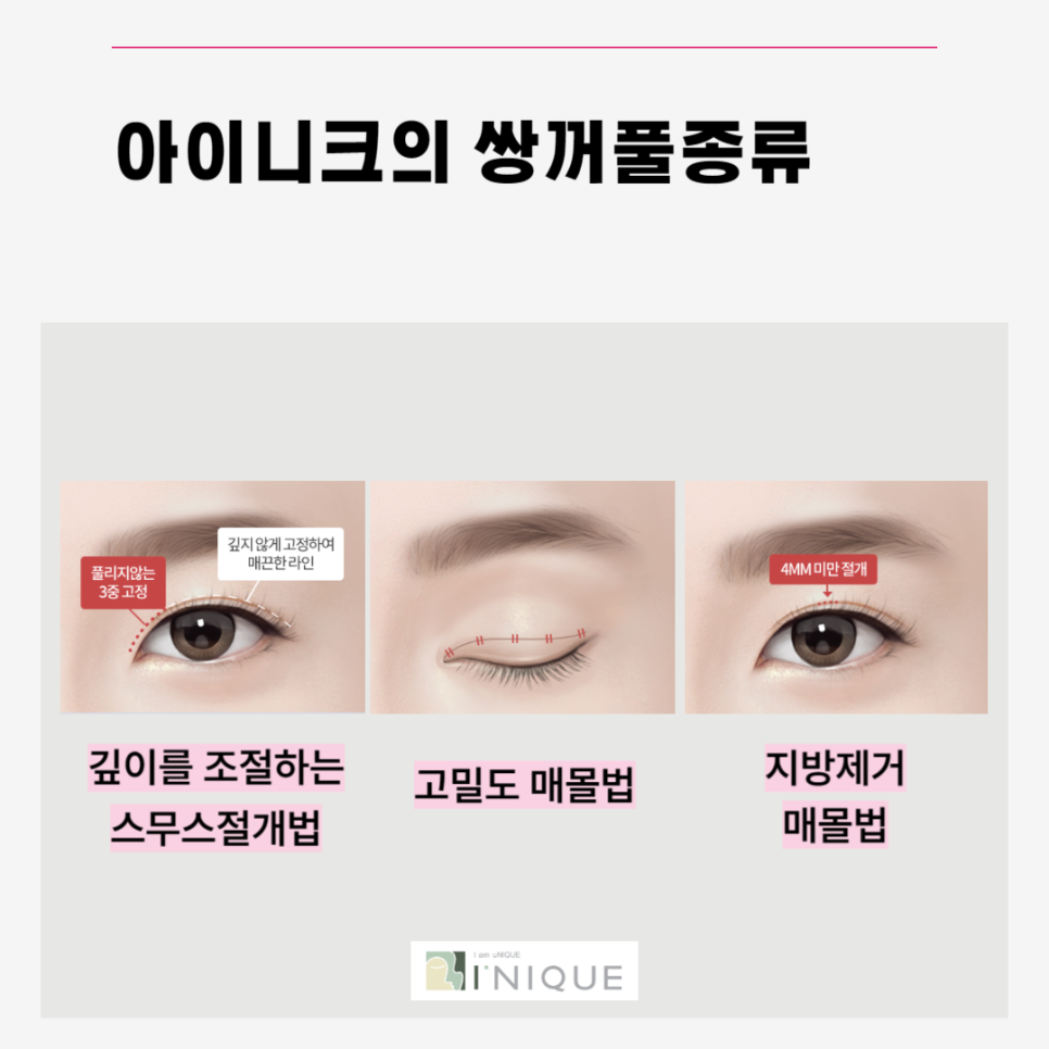 Types of Double Eyelid Surgery: Which Method Is Right for Me? image 2