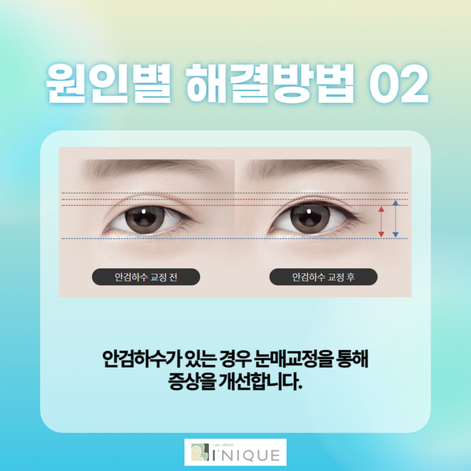 소시지눈 어떻게 하면 해결할 수 있을까? 관련 이미지 4