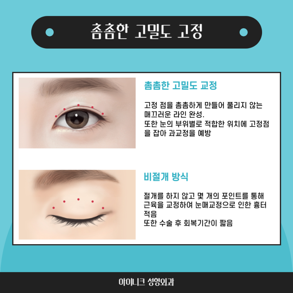눈처짐 수술, 일반 쌍수랑 무엇이 다를까? 관련 이미지 5