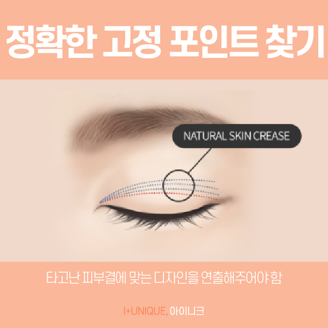 눈수술잘하는병원 이것을 고민하자 관련 이미지 4