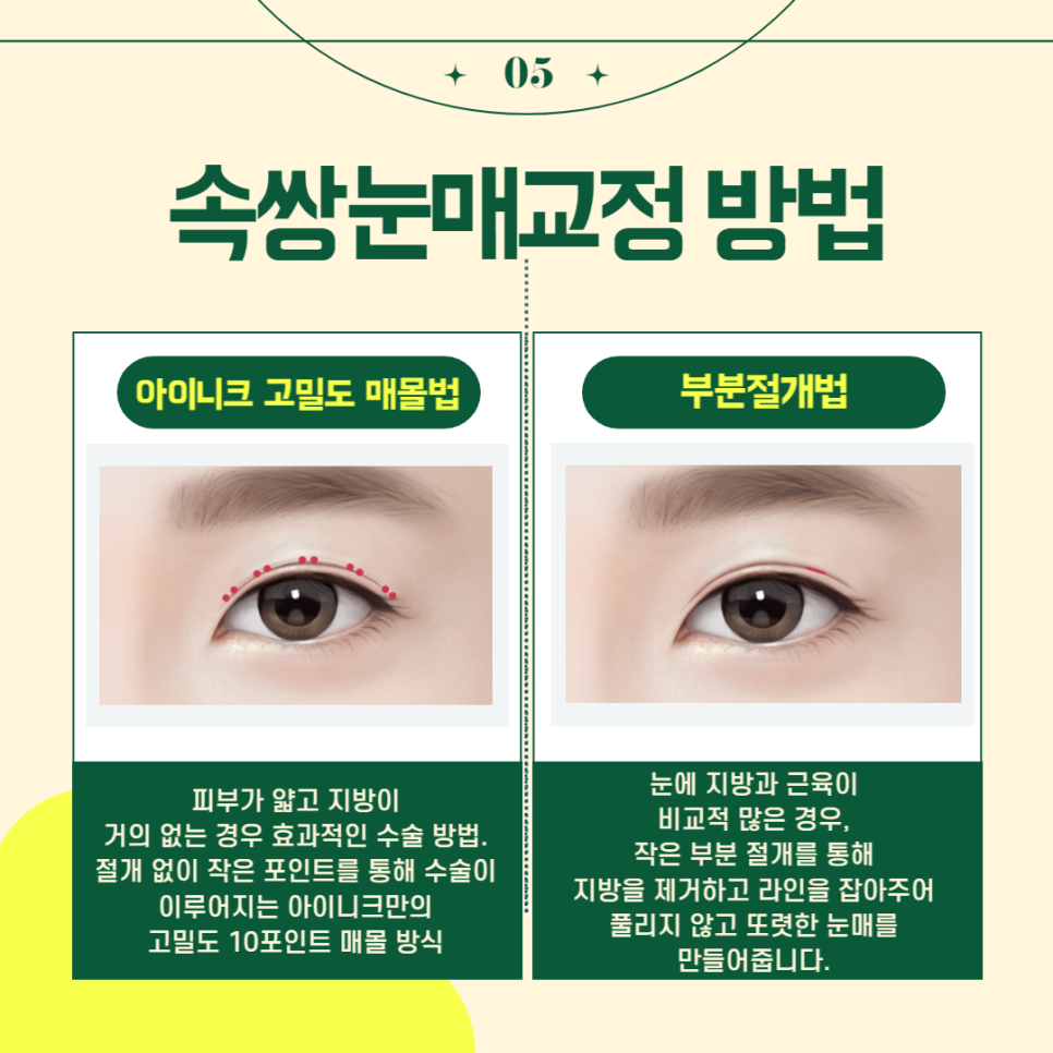 무쌍눈매교정술로 티나지 않는 또렷한 눈 만들기 관련 이미지 6