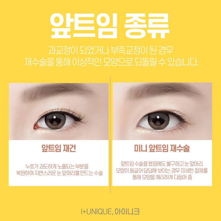 앞트임재건수술을 알아보고 있다면 이제는 아이니크성형외과로 결정하자 관련 이미지 2