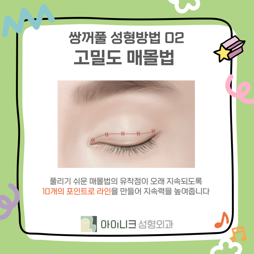 쌍꺼풀수술병원에서 알려드리는 종류와 선택 관련 이미지 11
