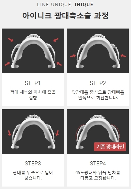광대뼈축소부작용 없이 자연스러운 내 얼굴! 관련 이미지 4