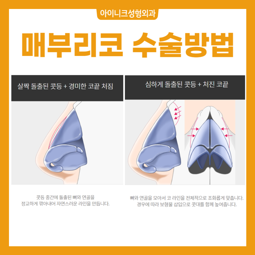 남자코성형후기 모음 - 낮은 코, 매부리코, 미간꺼짐 개선 효과를 확인해보세요 관련 이미지 6