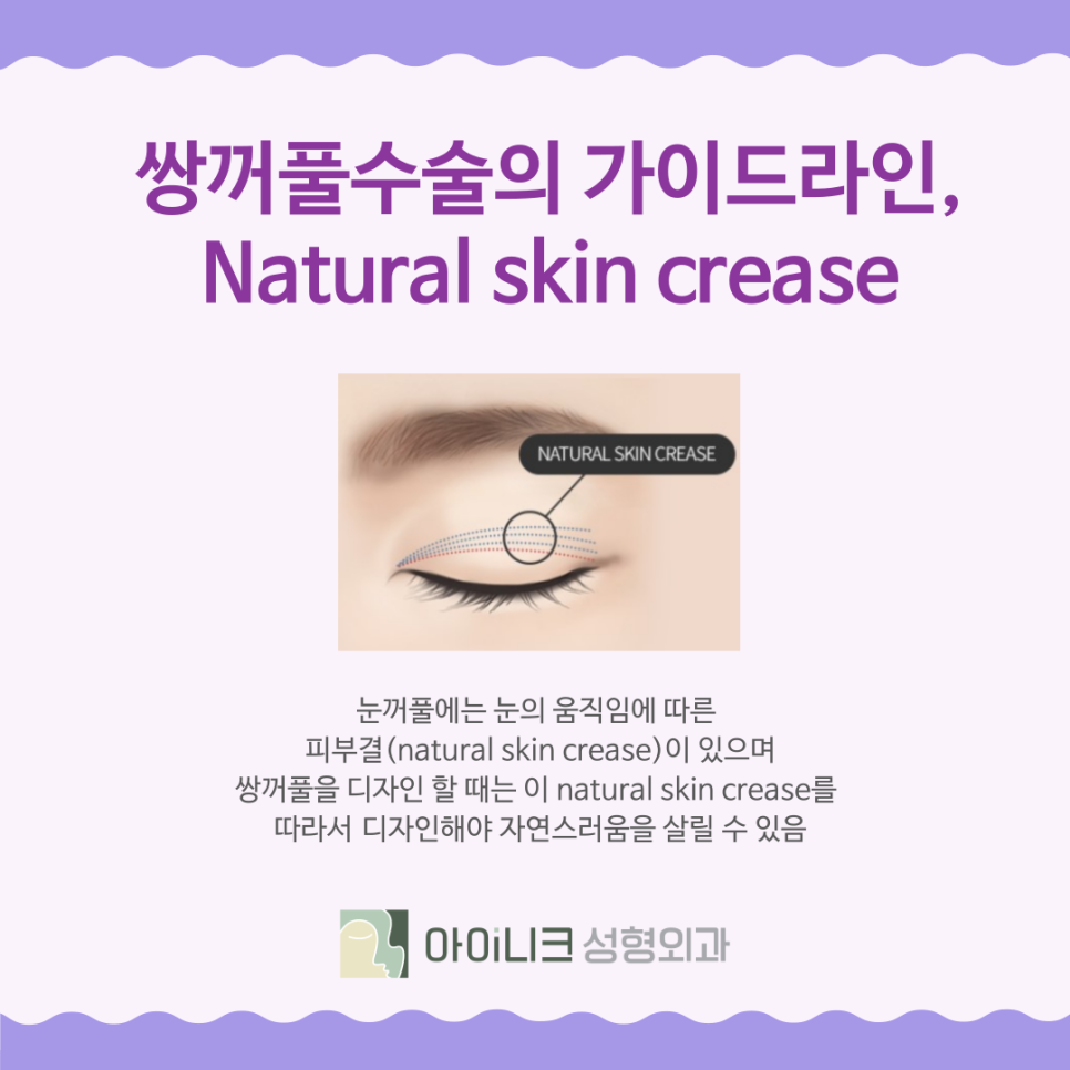 강남눈수술 쌍꺼풀은 자연스러운 디자인이 중요 관련 이미지 5