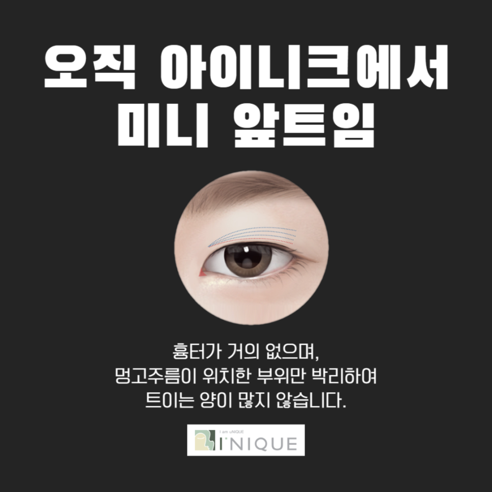 트임성형으로 답답한 눈매고민 해결 관련 이미지 5