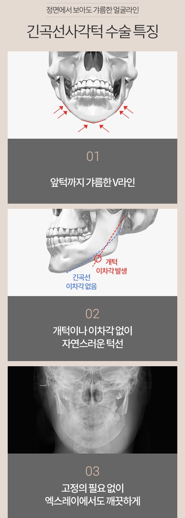 피질절제술로 정면에서도 V라인 관련 이미지 5