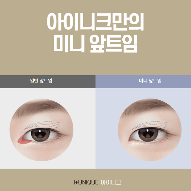 서울눈재수술 성공하고 싶다면? 관련 이미지 5