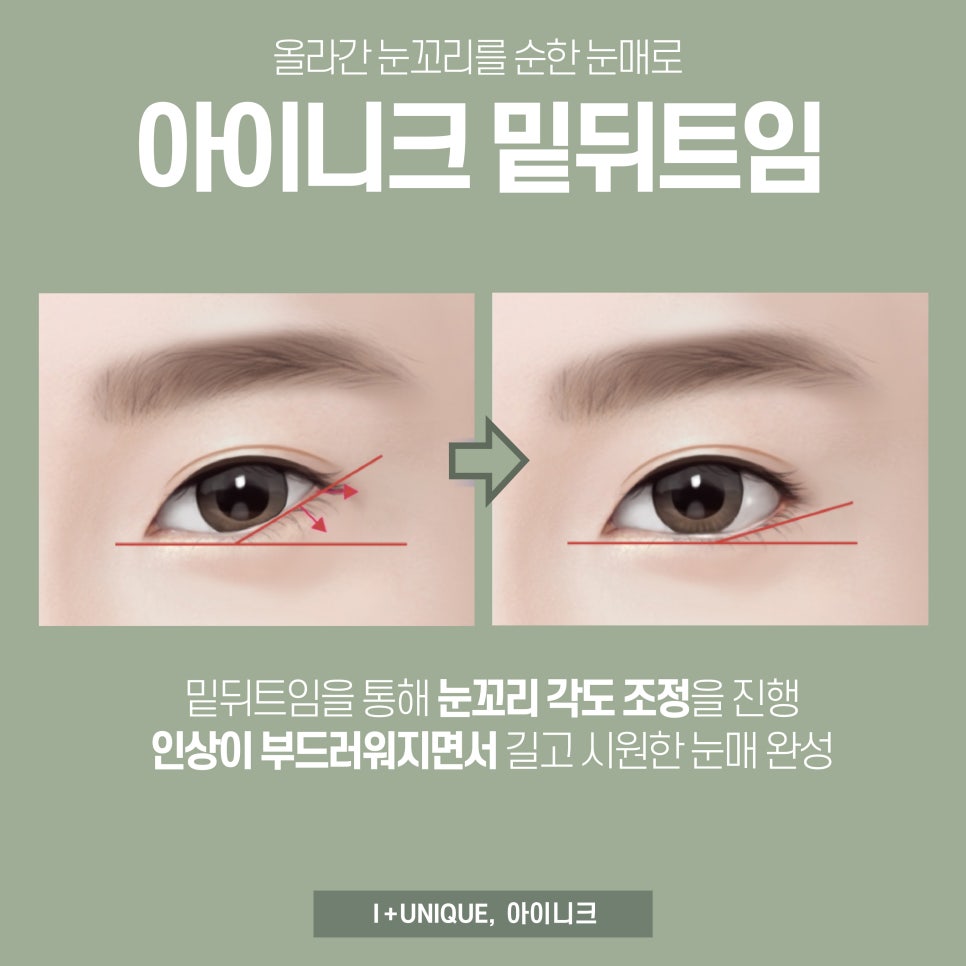 뒷트임잘하는곳 아이니크성형외과에서 완벽분석 관련 이미지 4