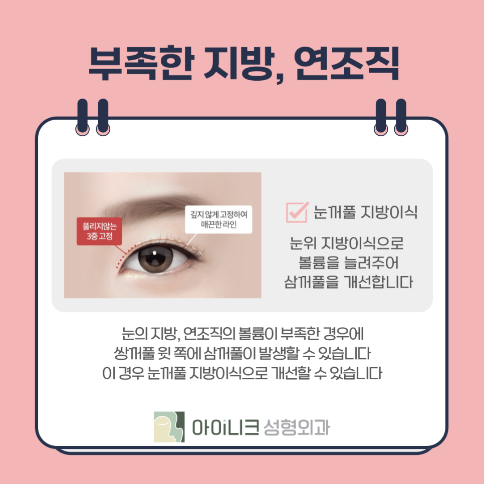 눈재수술로 삼꺼풀 부작용 해결하기 관련 이미지 8