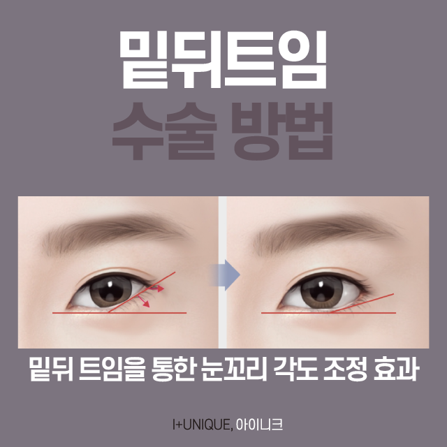 뒤밑트임 성형 성공하는 방법은? 관련 이미지 4