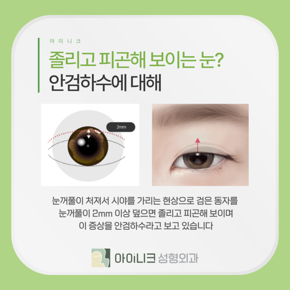 안성형 안검하수 교정, 전후 차이가 이렇게 크다고? 관련 이미지 5