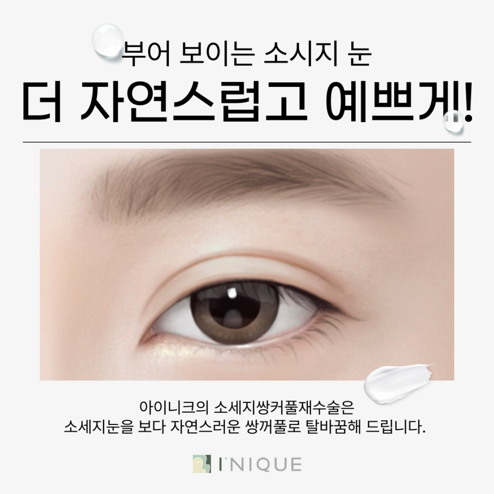 소세지쌍꺼풀재수술, 고민되시나요? 관련 이미지 2