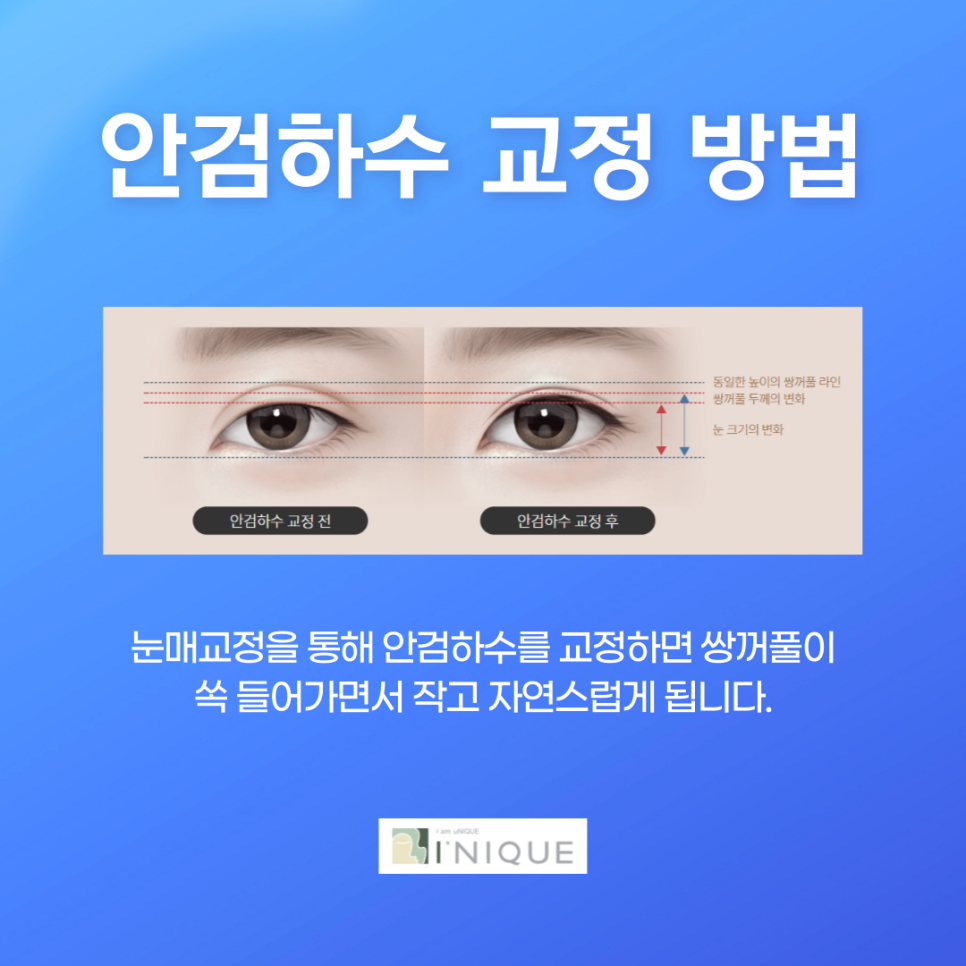 쌍커풀재수술잘하는곳 맞춤으로 자연스럽게 관련 이미지 4