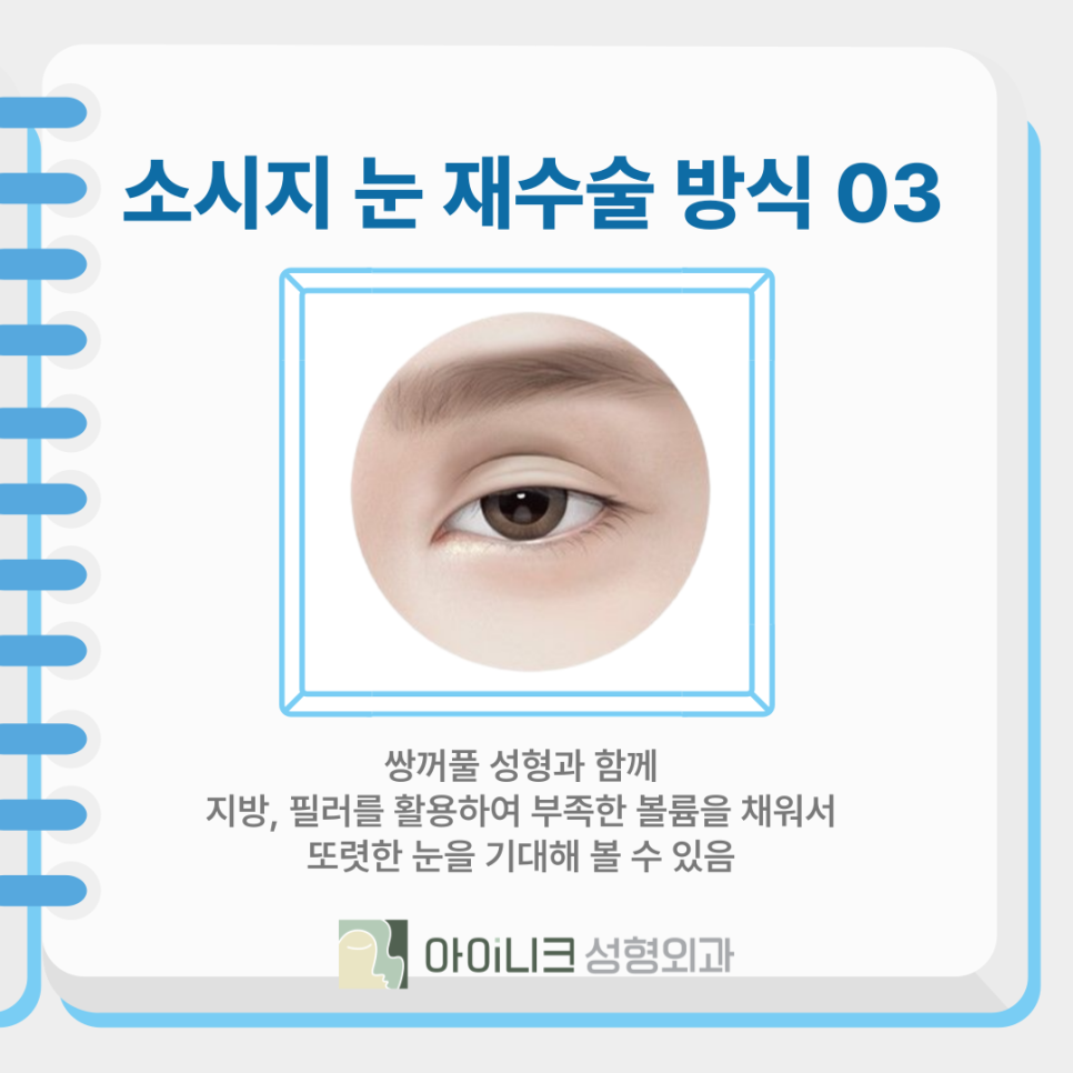 쌍꺼풀재수술비용과 함께 꼼꼼하게 따져야 할 것 관련 이미지 10