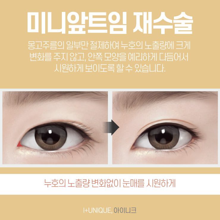 다시 내 눈을 크고 시원하게, 트임재수술도 아이니크성형외과 관련 이미지 4