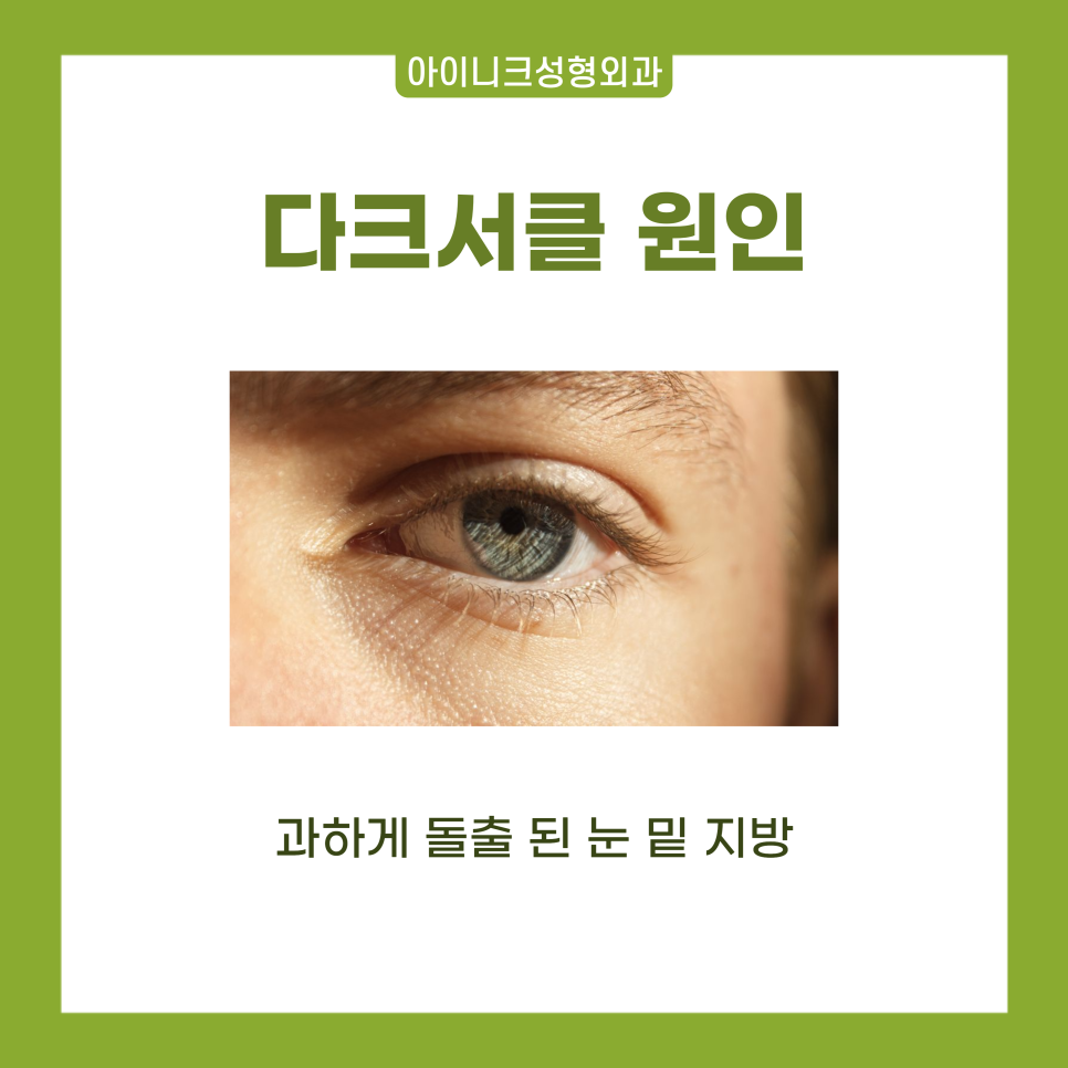 수술 다음 날에도 출근 가능한 다크서클수술 알아보기 관련 이미지 2