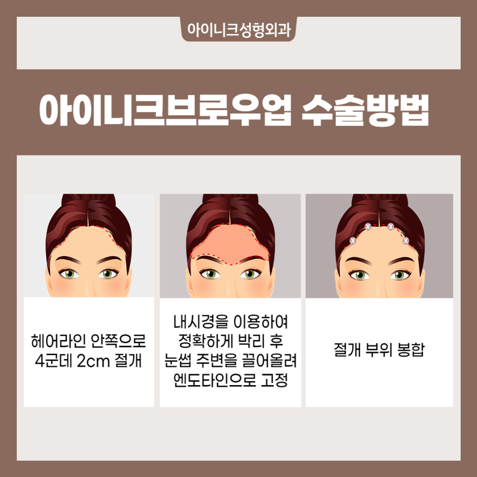 눈썹 올림술 (브로우업) 필요하다면? 관련 이미지 3