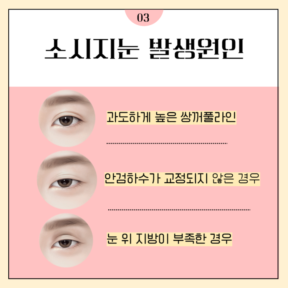 눈재수술병원 마지막이 되도록 관련 이미지 3