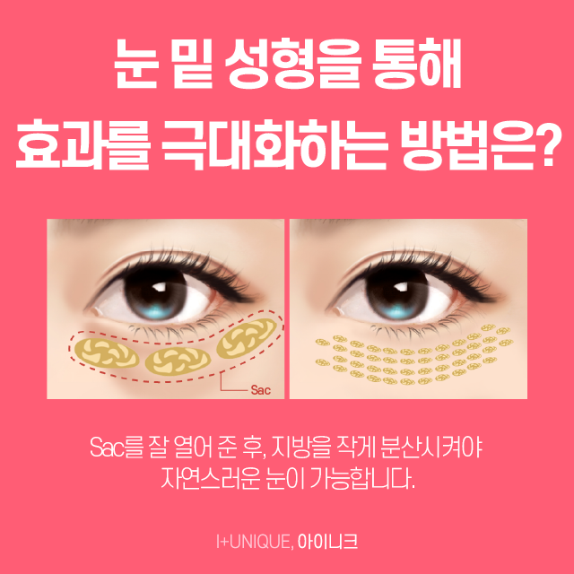 눈밑성형 여기로 결정하면 후회없죠 관련 이미지 4