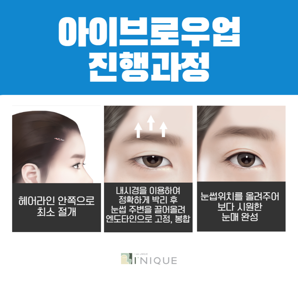 눈썹수술로 더 또렷하고 시원한 인상을 만드세요! 관련 이미지 4