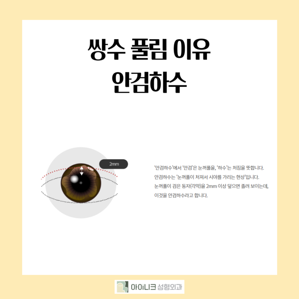 What Are the Reasons Double Eyelid Surgery Fails, and What Is the Right Revision Method? image 4