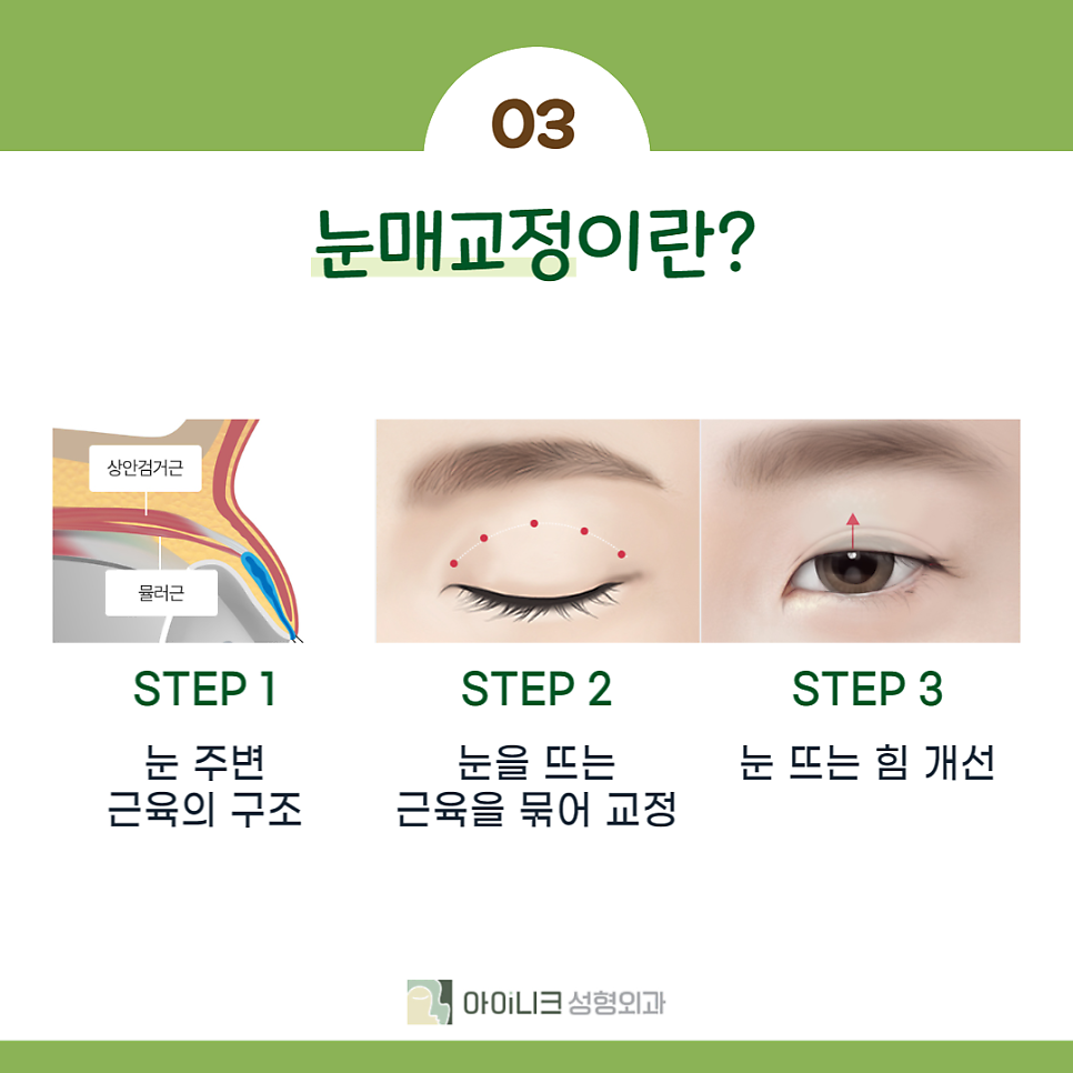 눈매교정 쌍수 차이는 무엇일까요? 관련 이미지 4