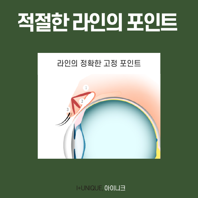 First Double-Eyelid Surgery: Know This and Nothing Else Before You Do It! image 5