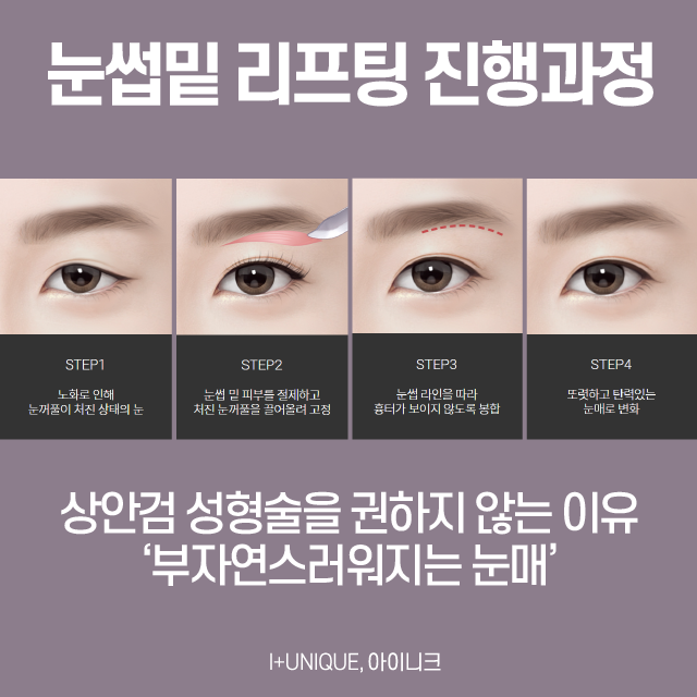 중년눈성형방법, 안전하고 완벽하게! 관련 이미지 3