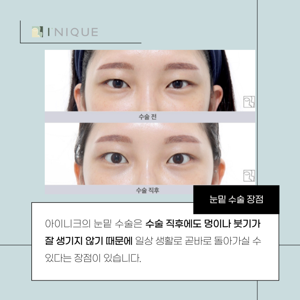 눈밑지방재배치수술후 변화를 기대한다면 관련 이미지 5