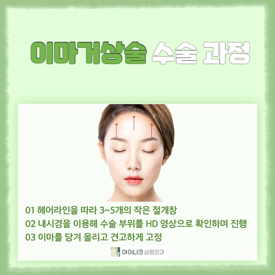 30대이마거상술로 깨끗한 이마 만들기 관련 이미지 5