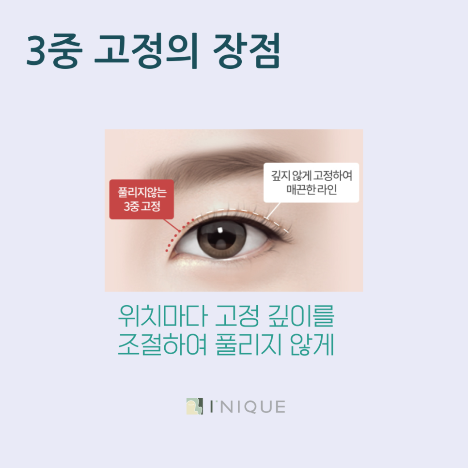 쌍수성형 잘하는 곳 선택하는 방법 관련 이미지 5