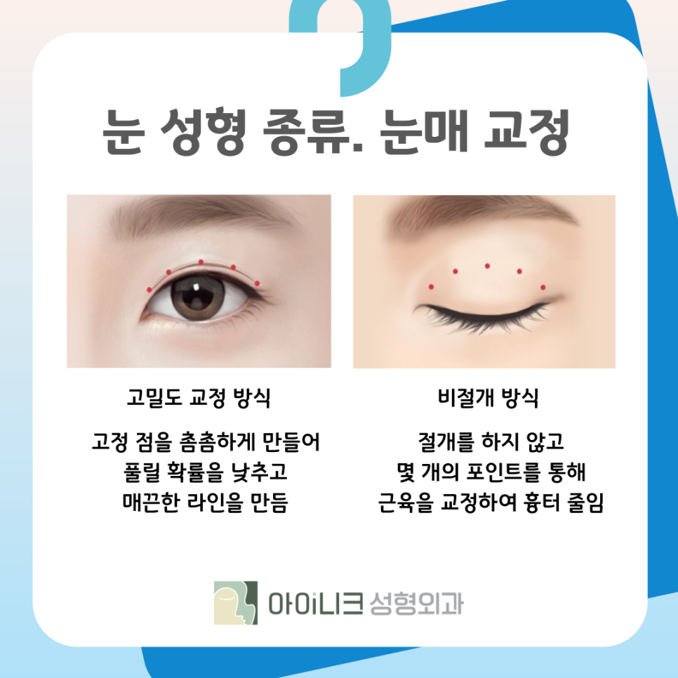강남성형외과유명한곳 눈 성형 종류가 궁금해요 관련 이미지 7