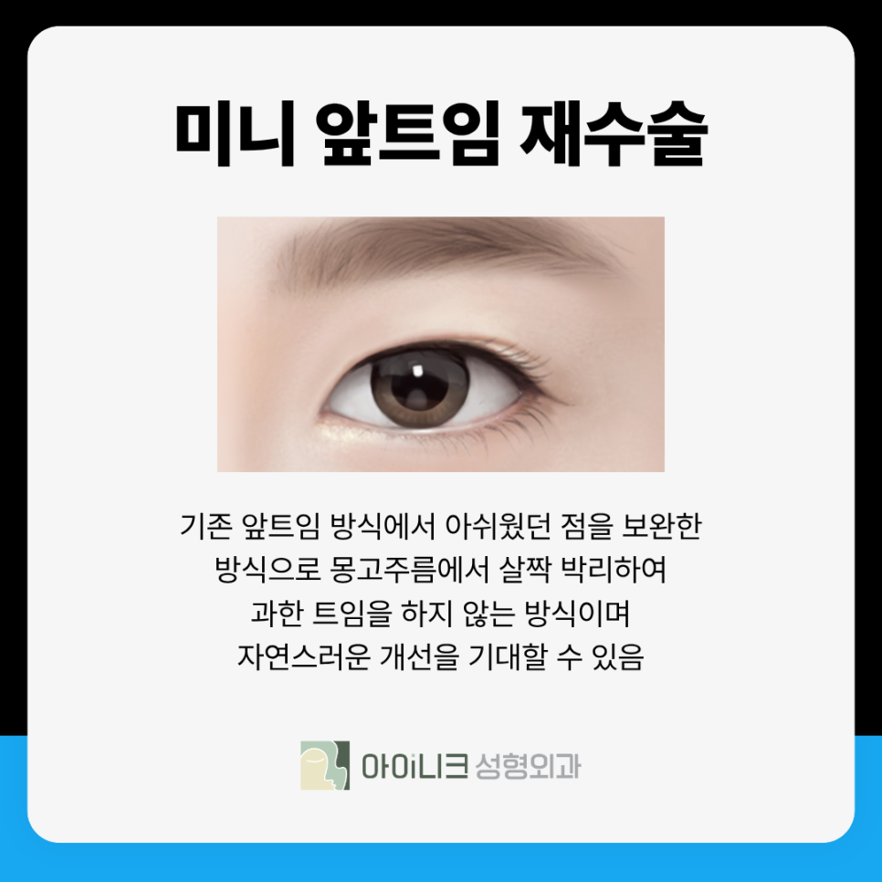 Revision Eye Surgery Clinic: What Can I Do About a Harsh Look Caused by Excessive Epicanthoplasty? image 7
