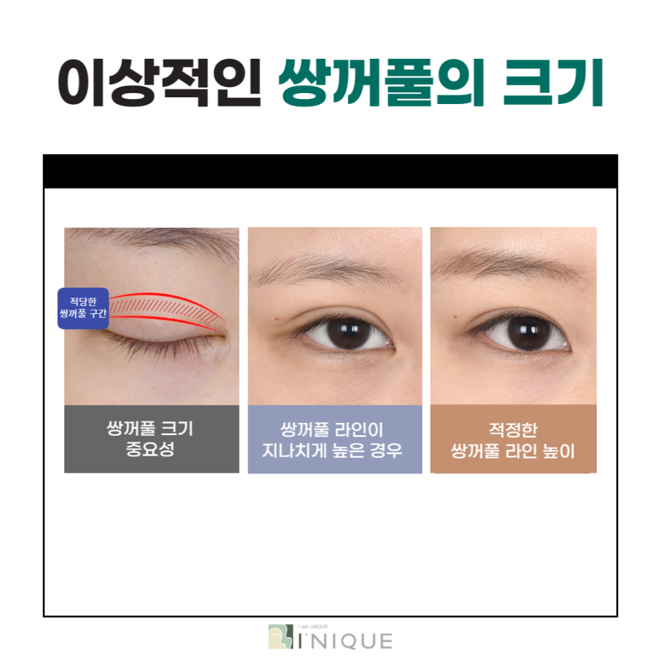 If You Want a Clear Change Before and After Double Eyelid Surgery image 2